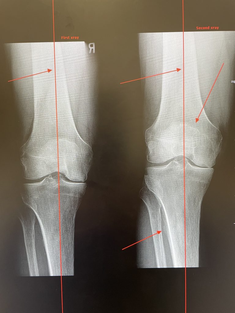 Knee pain before and after Shockwave Therapy